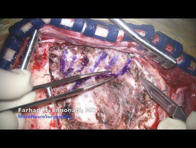Brain tumor surgery: A man with recurrent Atypical Meningioma and video of his surgery.