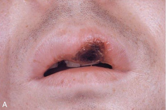 Primary syphilis oral lesion