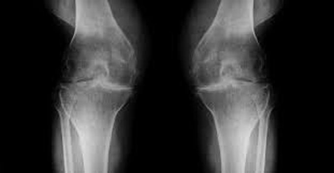 Treatment of degenerative joint disease