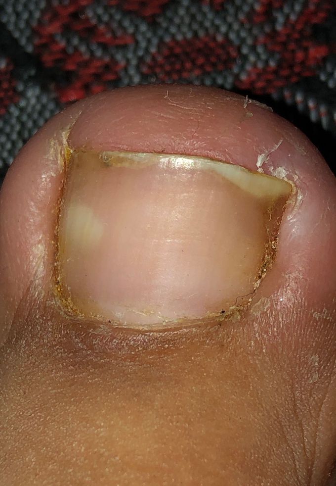 ingrown toenail