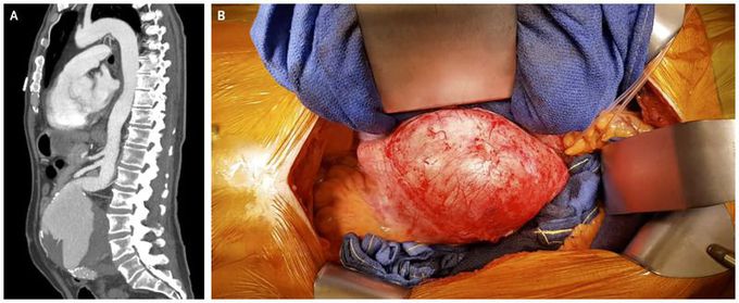 A Pulsatile Abdominal Mass