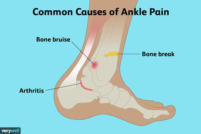 Common causes of ankle pain