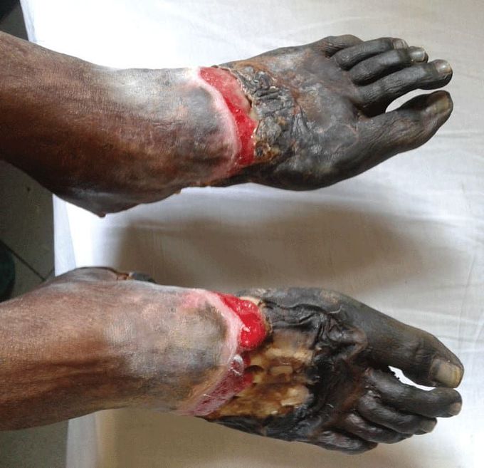 Gangrene