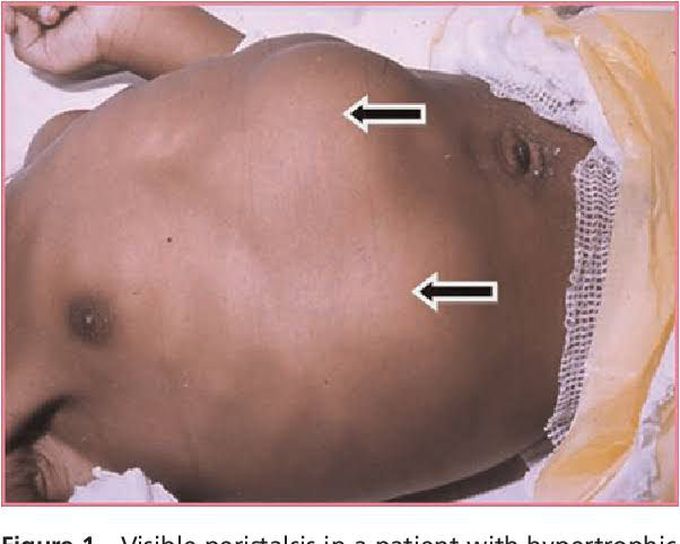 Pyloric stenosis treatment