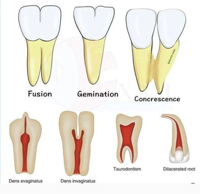 Dental Anomalies