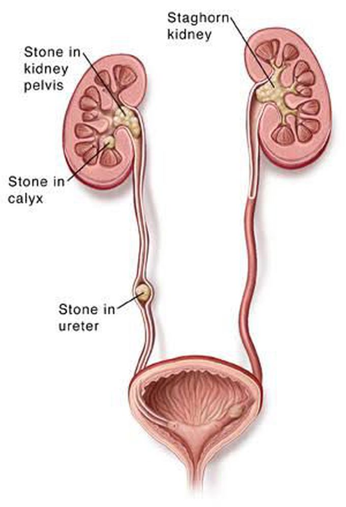Kidney and ureteral stones