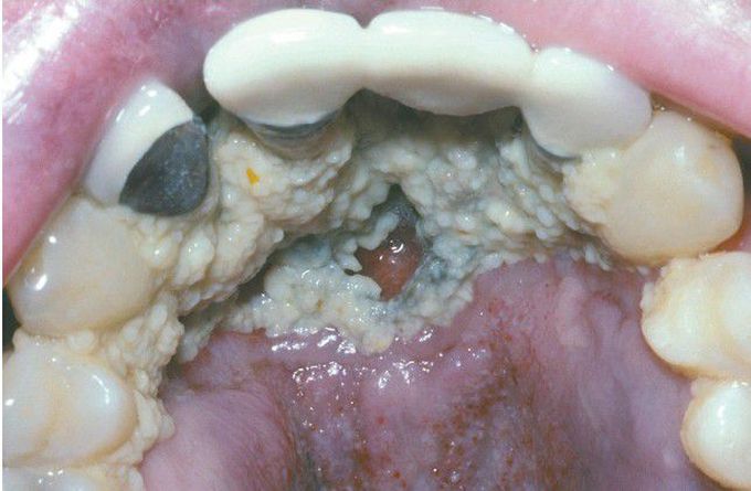 HIV-associated Necrotizing Stomatitis