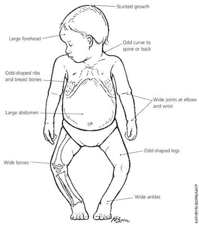 Symptoms of rickets