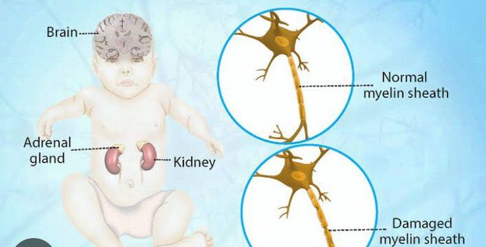 Treatment for Adrenoleukodystrophy