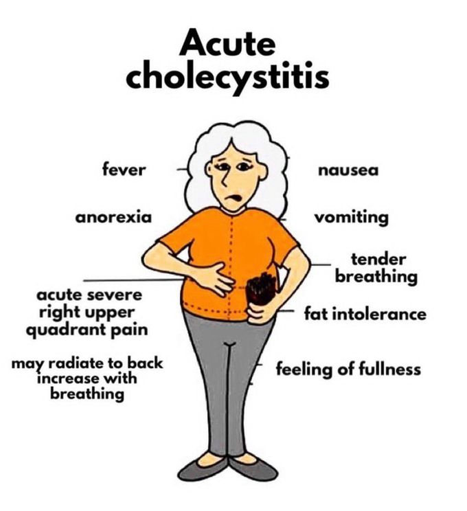 Acute Cholecystitis