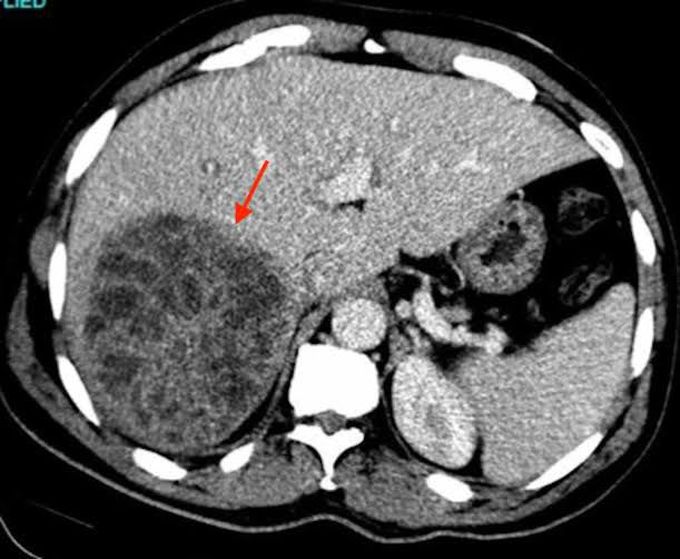 Liver abscess