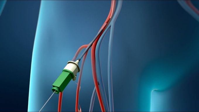 Coronary Angioplasty-3D model