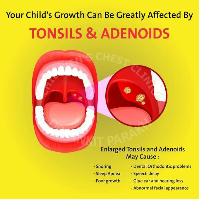 Adenoid causes