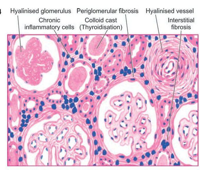 Chronic pyelonephritis.