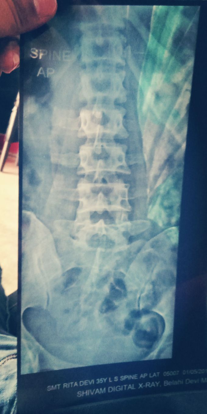 Spinal x-ray
