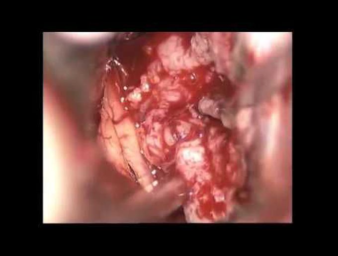 Post. interhemispheric transtentorial approach for meningioma at the posteromed. Tentorial incisura