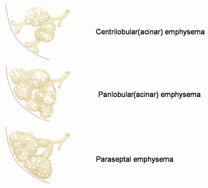 Types of Emphysema