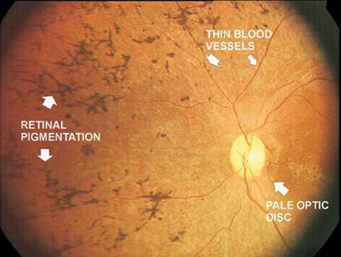 Retinitis Pigmentosa- Fundoscopy findings