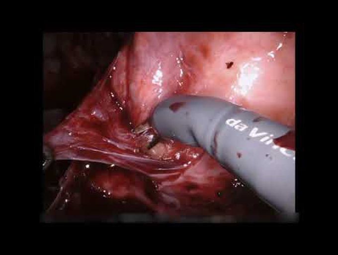 Robotic Lung Decortication After Bilateral Lung Transplantation