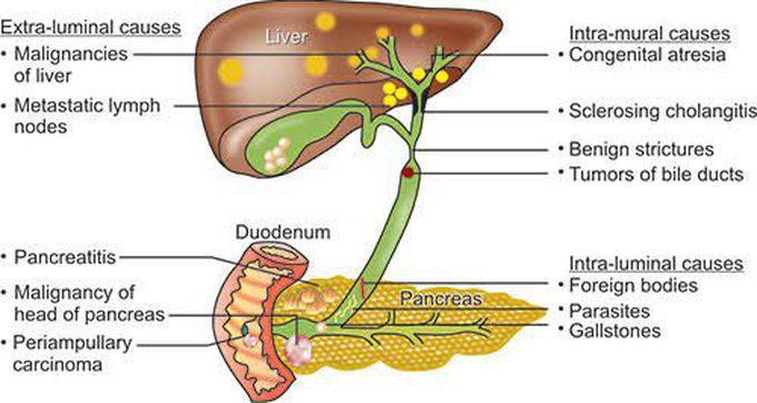 Obstructive jaundice