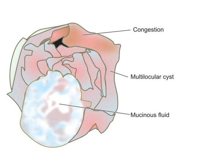 Mucinous cystadenoma of the ovary.