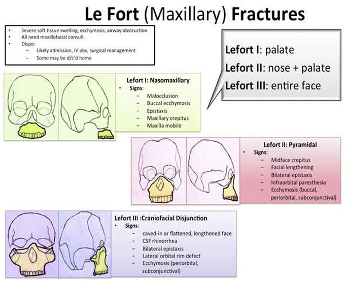 Le fort (Maxillary) Fracture