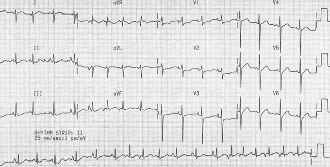 ECG Findings in Multifocal Atrial Tachycardia