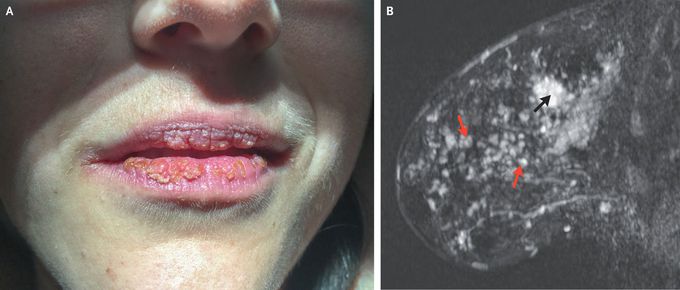 The Cowden Syndrome