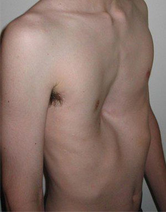 Causes of Pectus Excavatum
