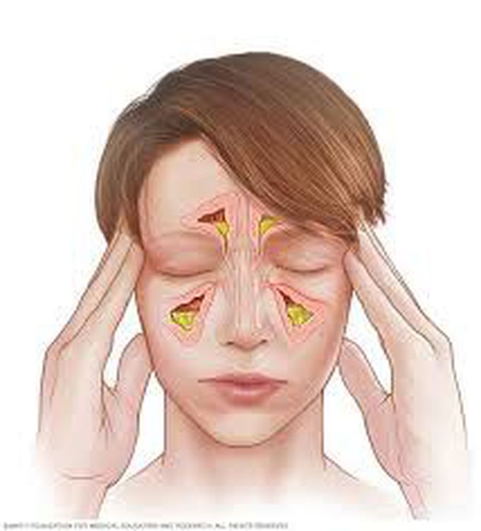 Sinusitis Medizzy