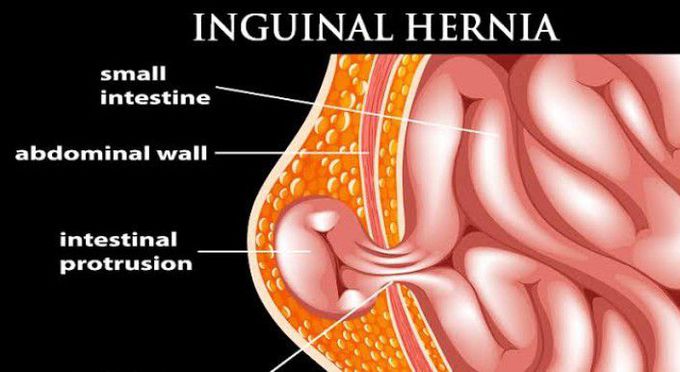 Inguinal hernias