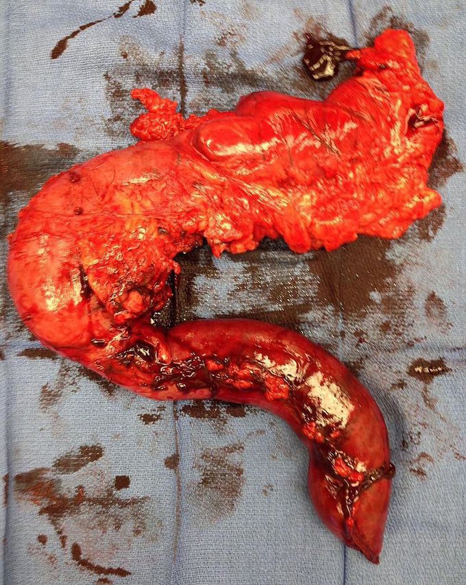 This image shows a Whipple’s specimen for pancreatic head cancer.  