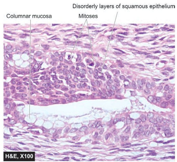 Uterine cervical dysplasia