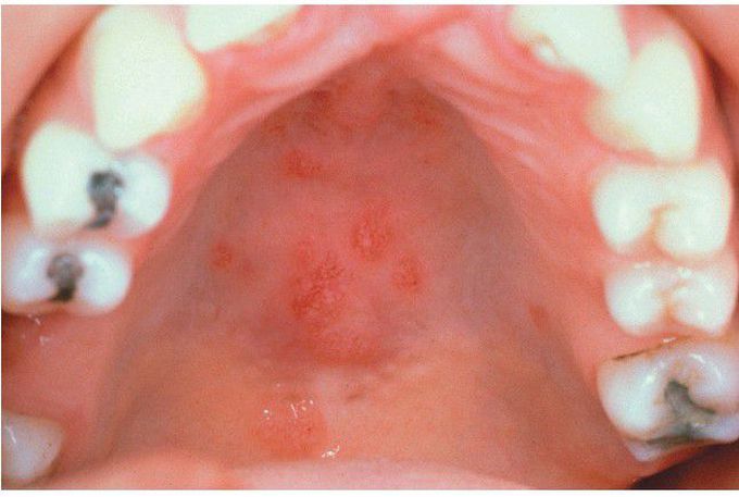 Sarcoidosis