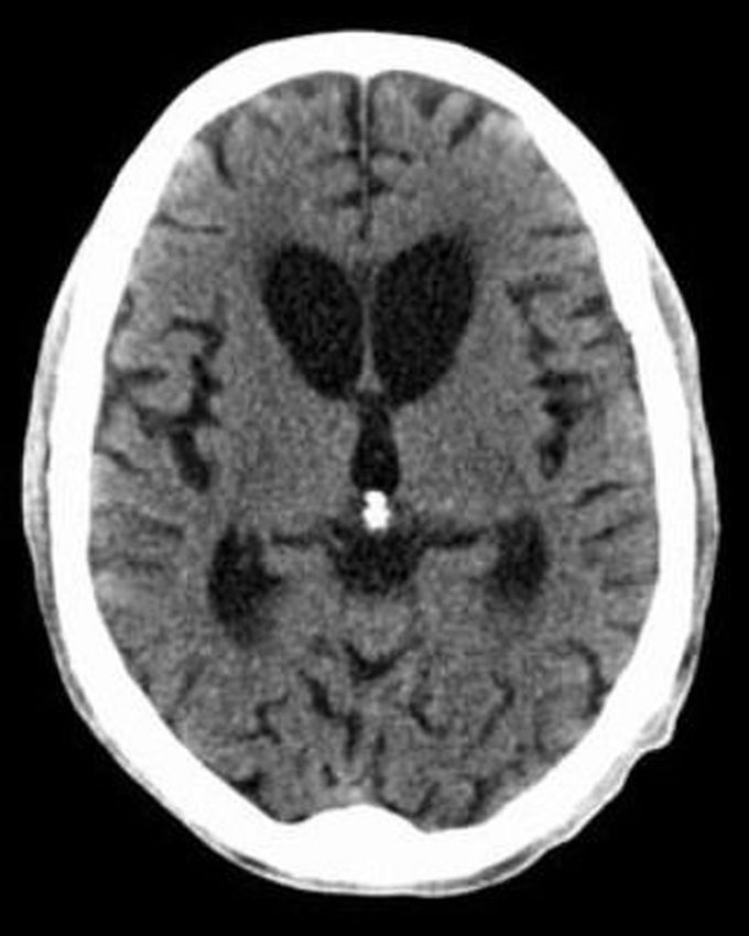 Case of Huntington's Disease