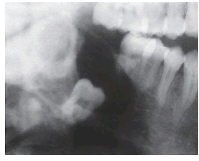 Unicystic ameloblastoma