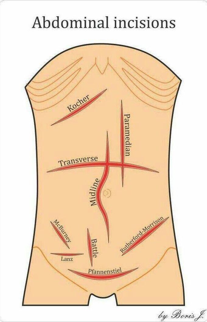 Abdominal incisions