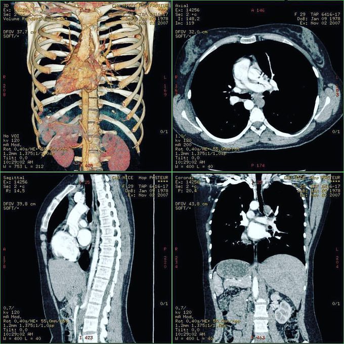 CT Scans of a patient with Situs inversus. 