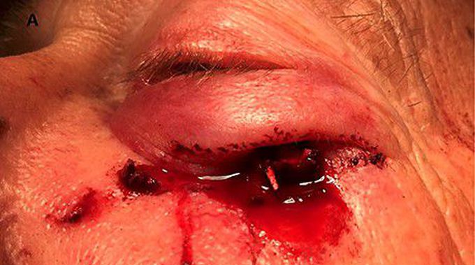 Twig in the Eye: A Case Report