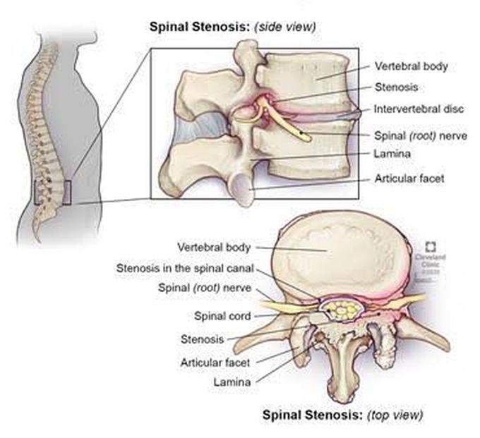 Spinal stenosis