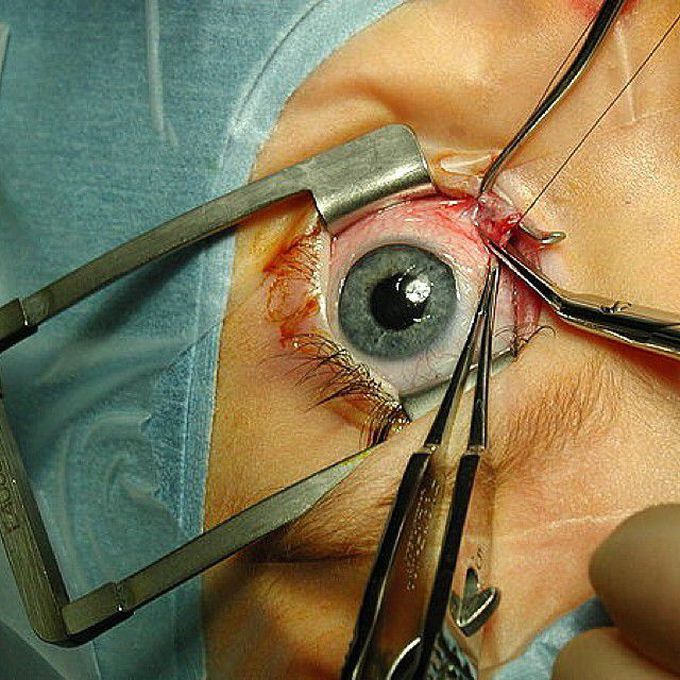 Strabismus surgery