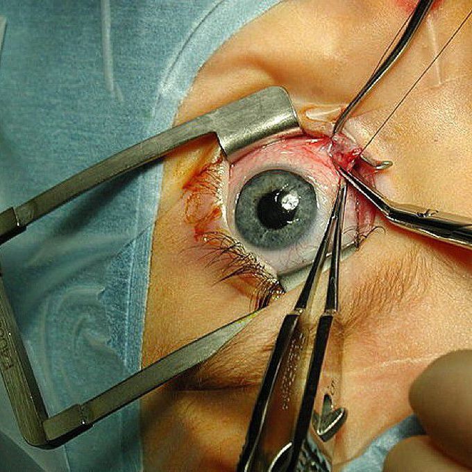 Strabismus surgery