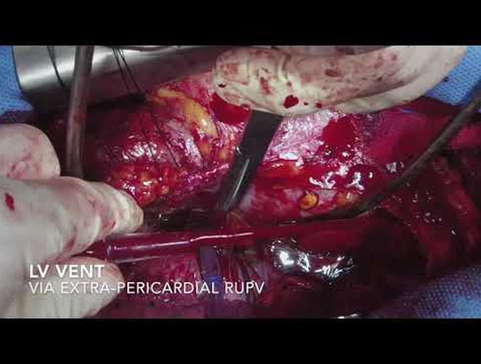 Reoperation for Annuloaortic Ectasia With Marfan Syndrome: Cabrol Procedure and Cabrol Patch