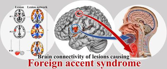 Foreign Accent Syndrome