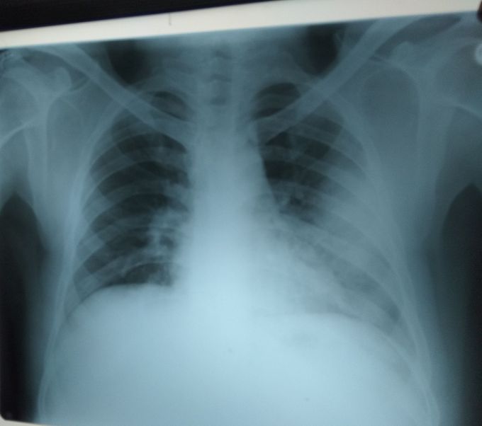 Pneumonia
