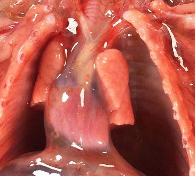 Pulmonary hypoplasia