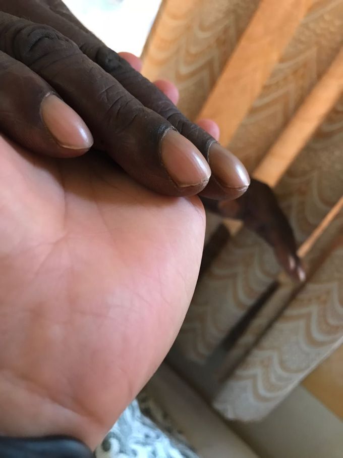 Clubbed nails