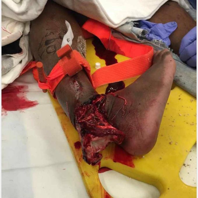 Heavy machinery accident causing almost complete avulsion of the foot with tibia protruding through the wound. 