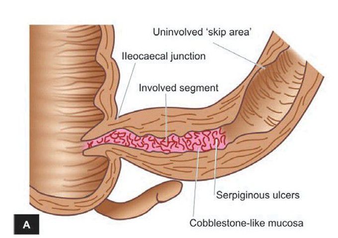 Crohn’s disease of the terminal ileum