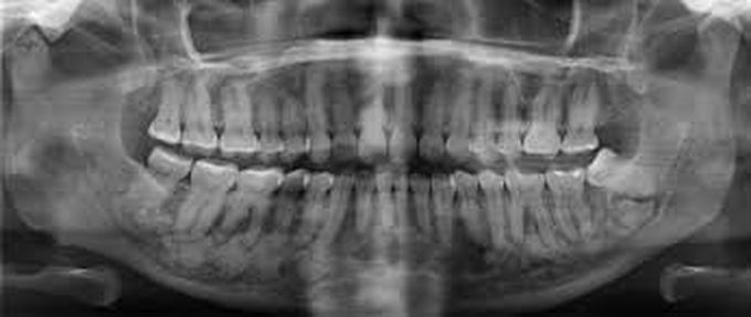 Cemento osseous Dysplasia